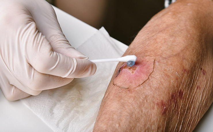 Thuisverpleging wondzorg